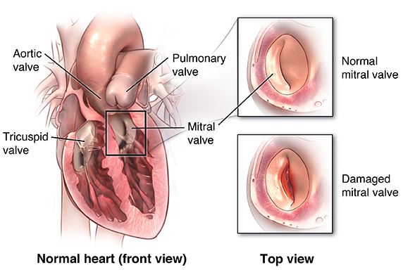 Heart Valve Surgery Halifax Health
